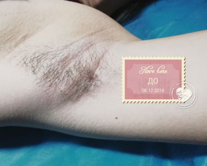 Шугаринг Симферополь  Армавир