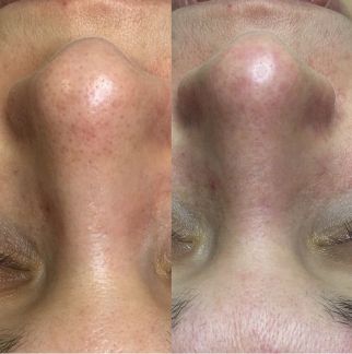 Шугаринг, уход за лицом и телом  Армавир