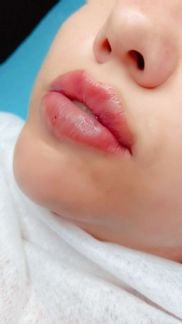 Косметолог, аугментация губ  Армавир