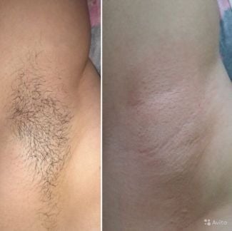 Депиляция  Армавир