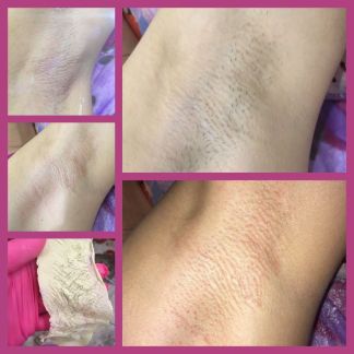 Депиляция воском  Армавир