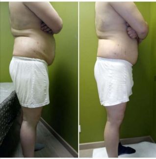 Антицеллюлитный массаж, массаж лица  Армавир