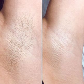 Шугаринг (депиляция сахар/воск) Ялта  Армавир