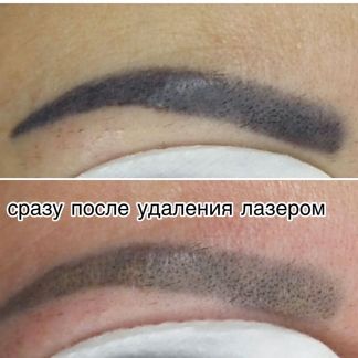 Удаление тату и татуажа  Армавир