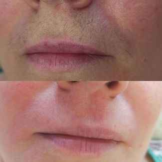 Шугаринг, воск  Армавир