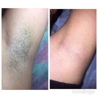 Депиляция Женская/мужская  Армавир