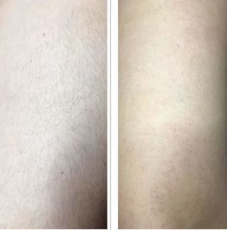 Электроэпиляция  - купить на сайте объявлений Армавир онлайн