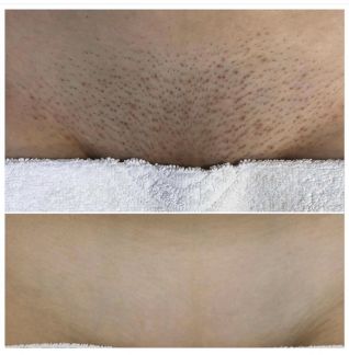 Лазерная эпиляция № 1 в мире Candela GentleLase  - купить на сайте объявлений Армавир онлайн